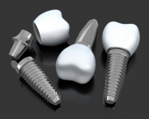 dental implants